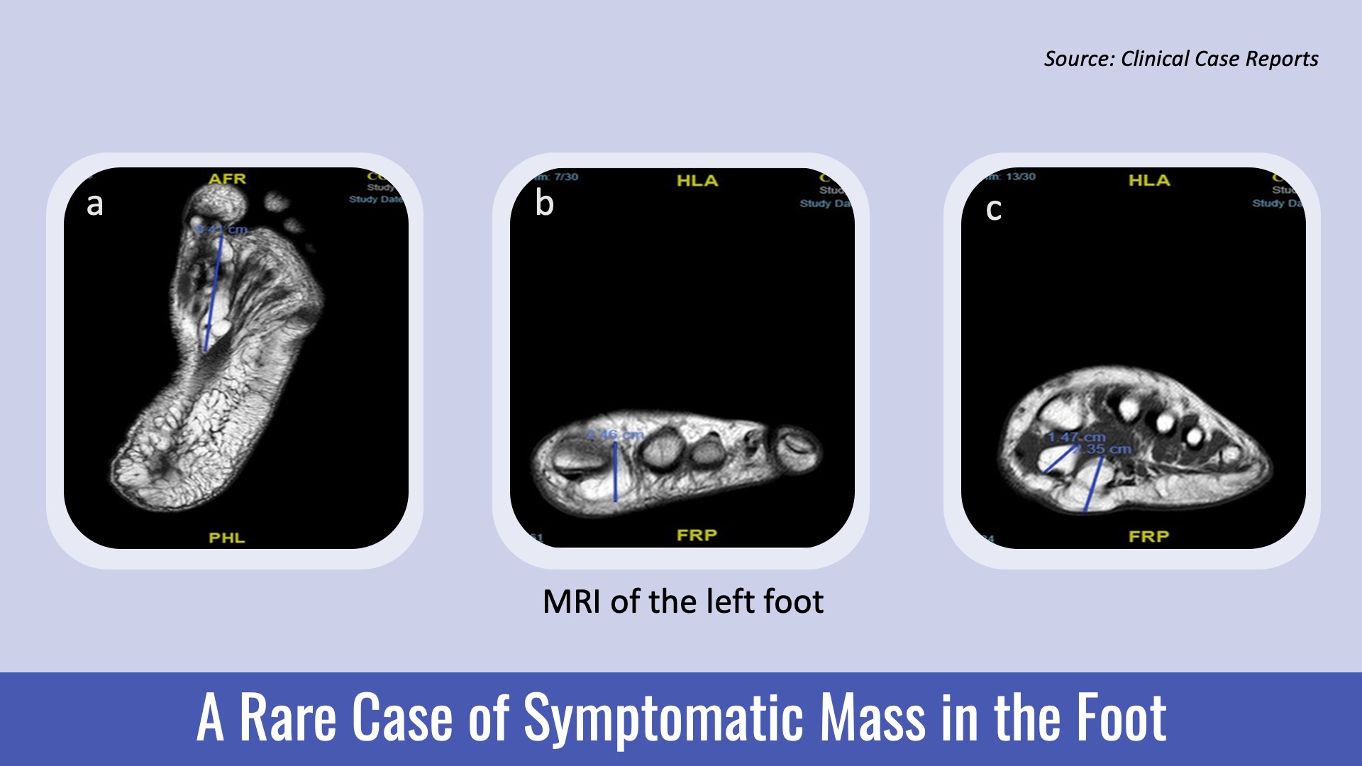 A Patient with a Mass in the Plantar Region of the Foot