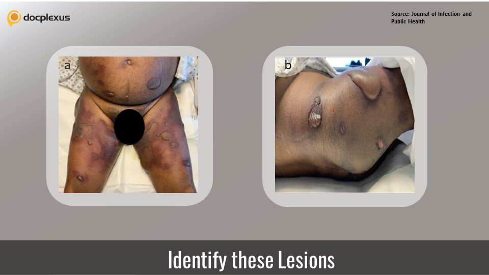 Painful Eruptions After COVID-19 Vaccination - What’s Your Diagnosis?