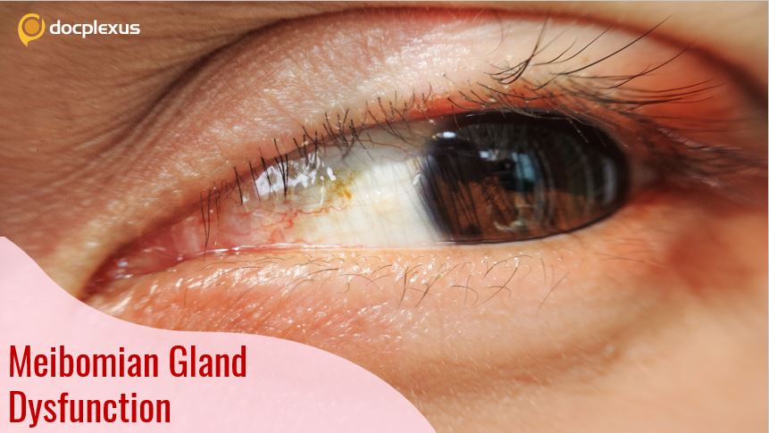 Role of Meibomian Gland in Thyroid Eye Disease (TED)