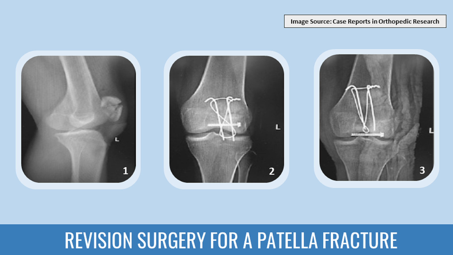 Suggest the Most Appropriate Intervention for Reconstructing the Patella Fracture