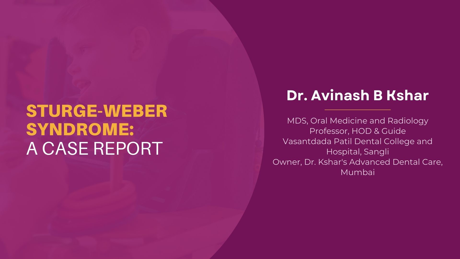 Sturge-weber Syndrome: A Case Report