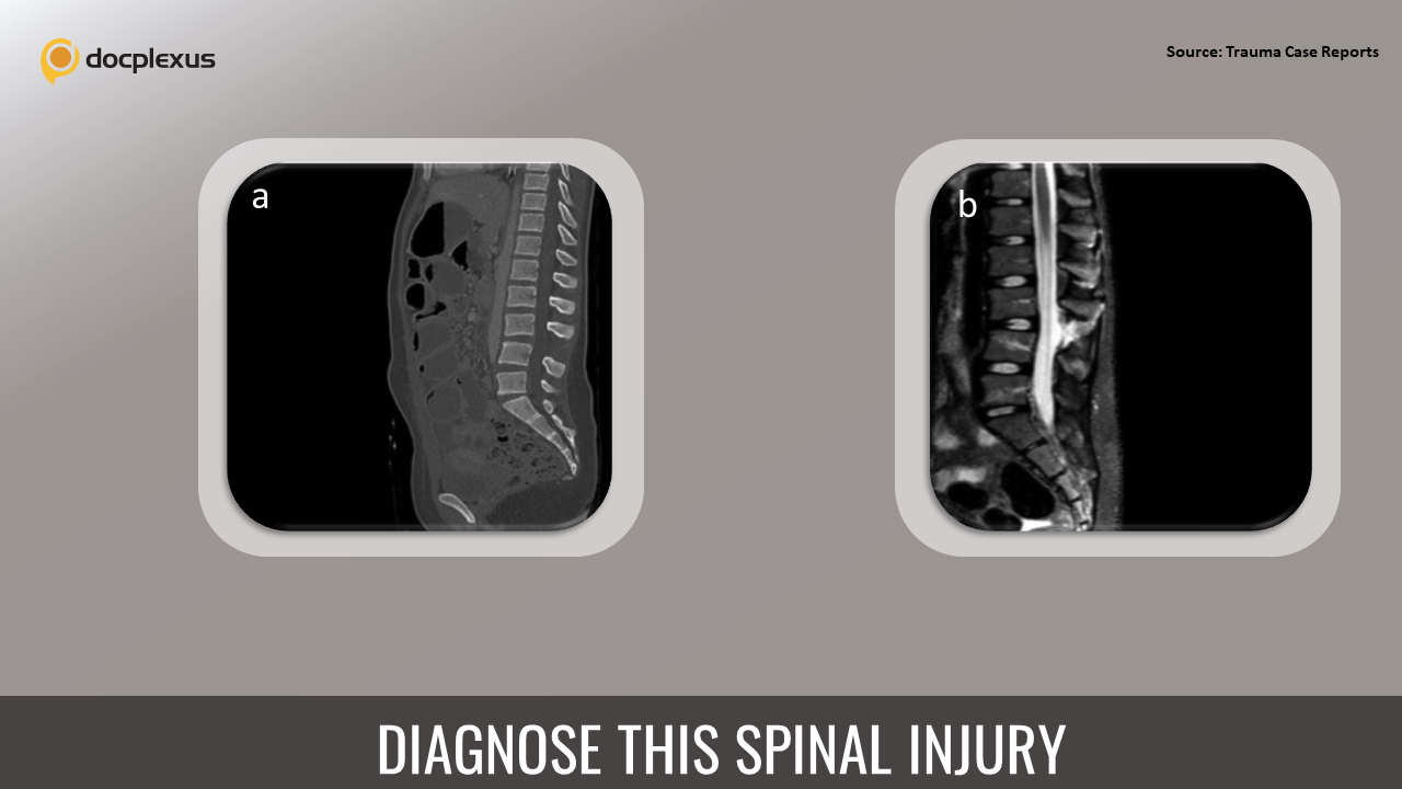 Identify the Spinal Injury