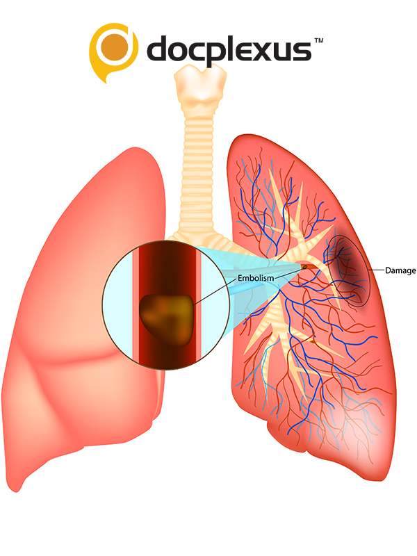 A Case-based Discussion on Pulmonary Embolism and Use of PCSK9 Inhibitors