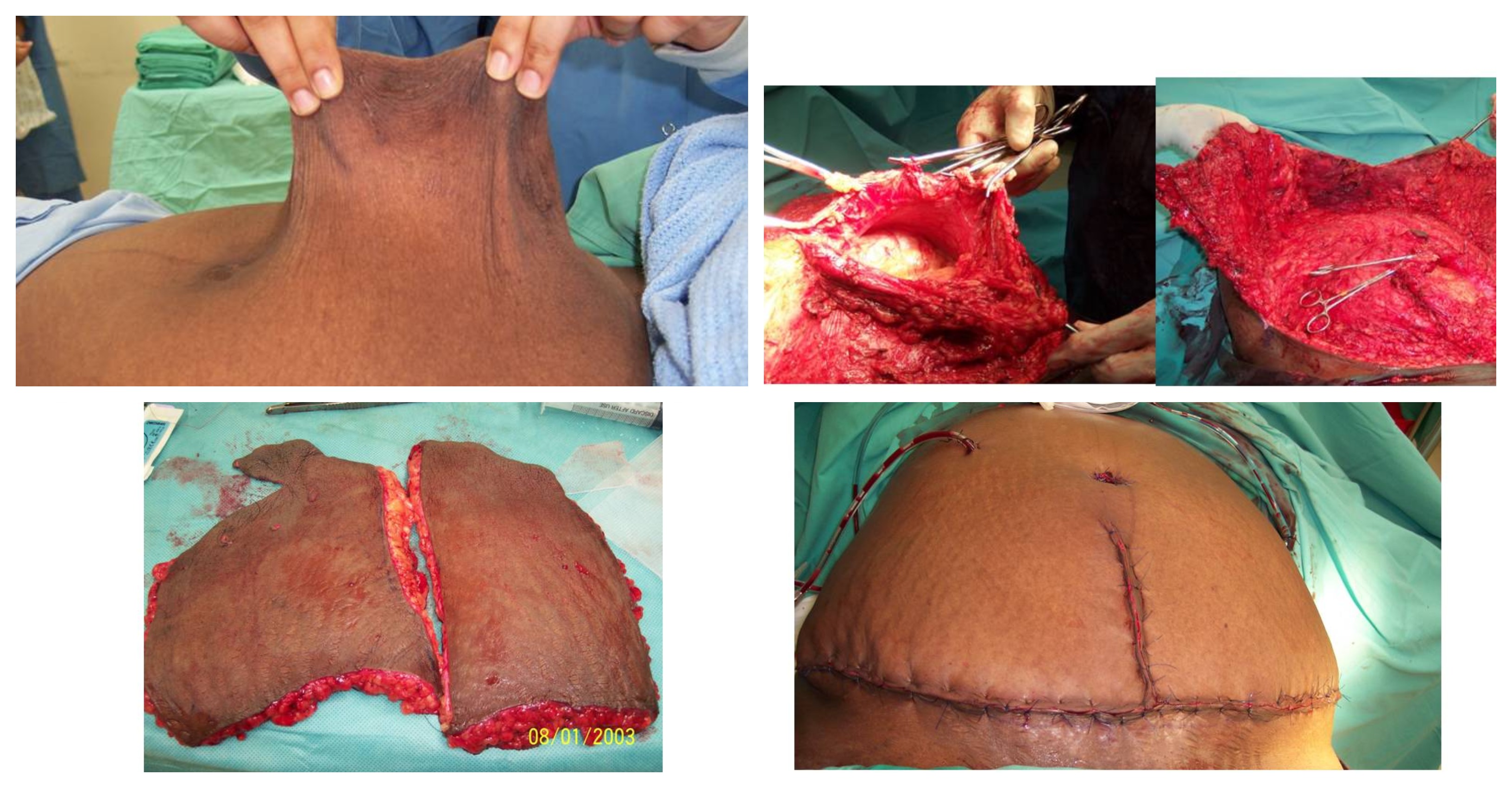 Various Stages of Abdominoplasty With Repair of Ventral Hernia