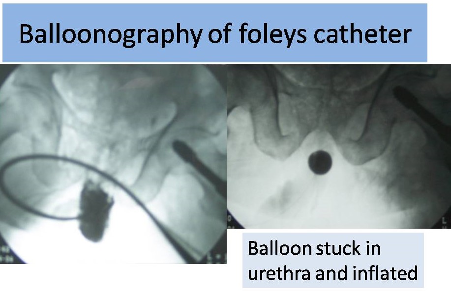 Balloonography of Foleys Catheter Stuck in Urethra