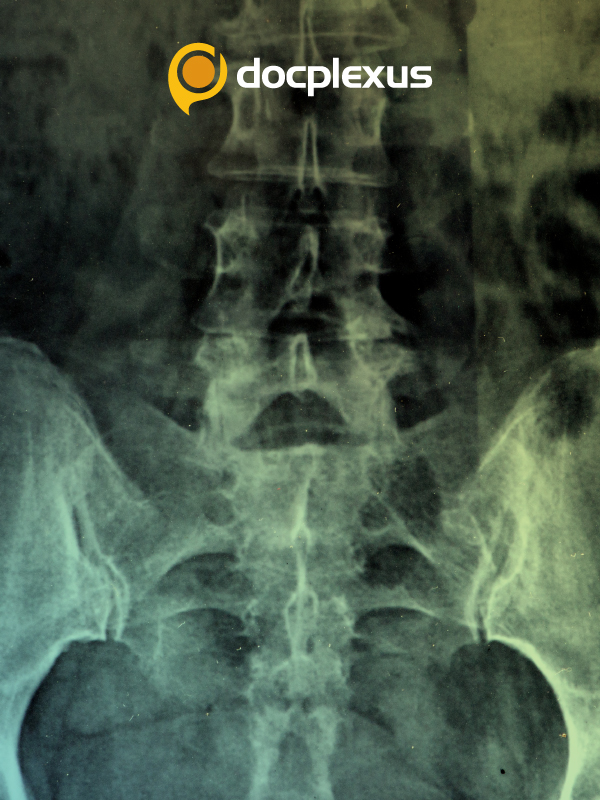 Women with Hypoglycemia at a Risk for Osteoporosis