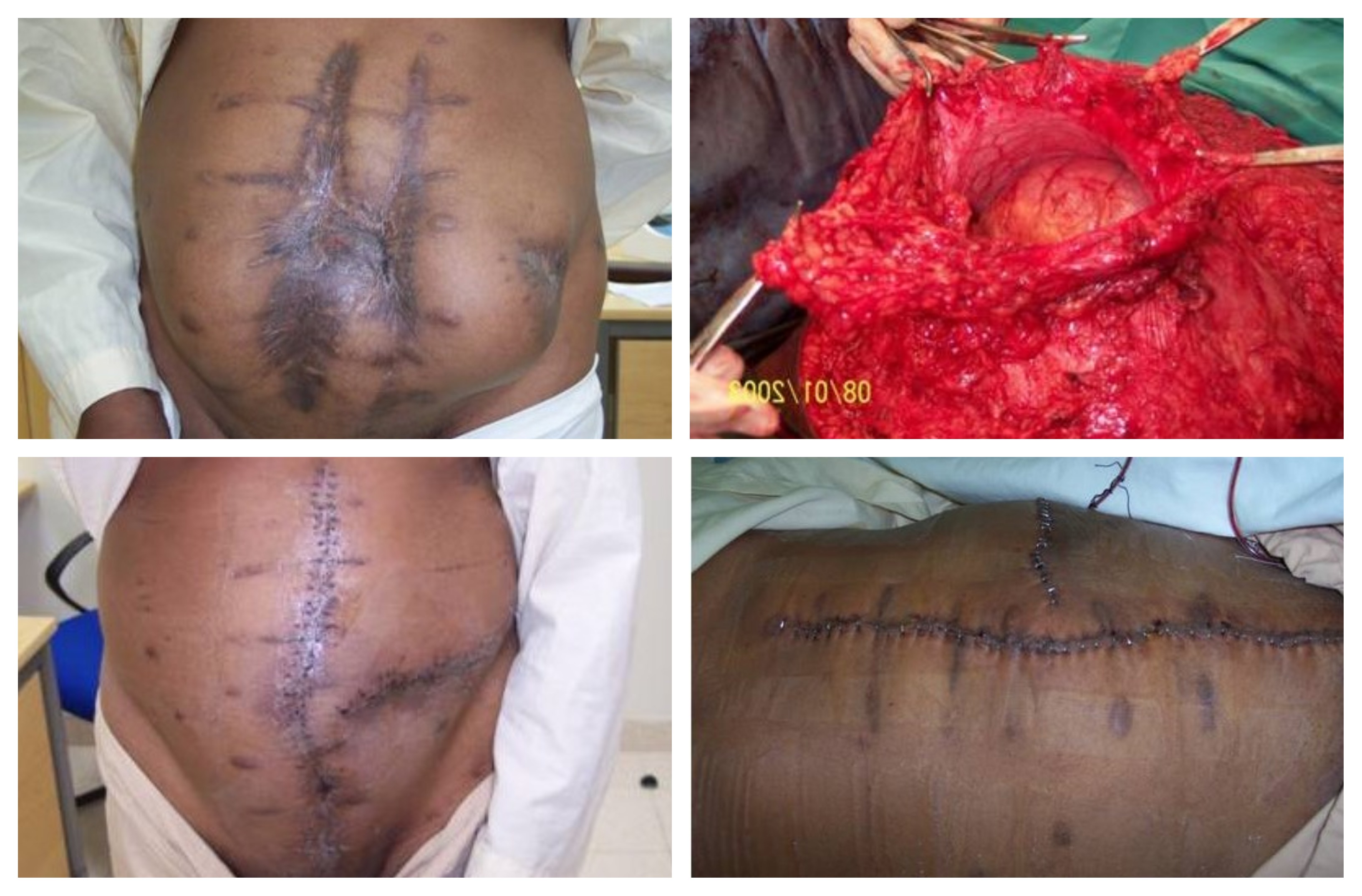 Abdominoplasty After Multiple Operations