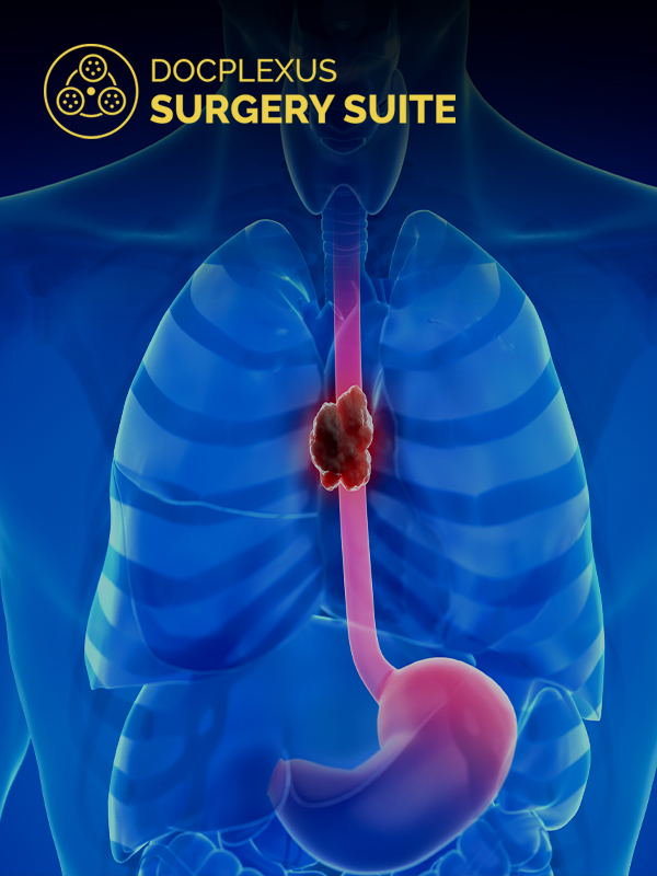 Mediastinal Masses & the Role of Minimally Invasive Surgery in Their Treatment