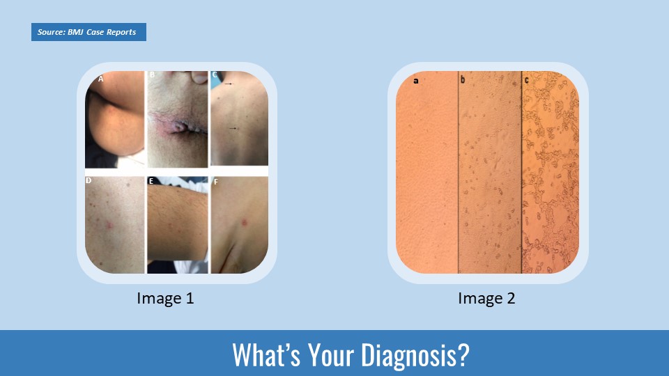 Identify the Cause of Skin Lesions in This Patient
