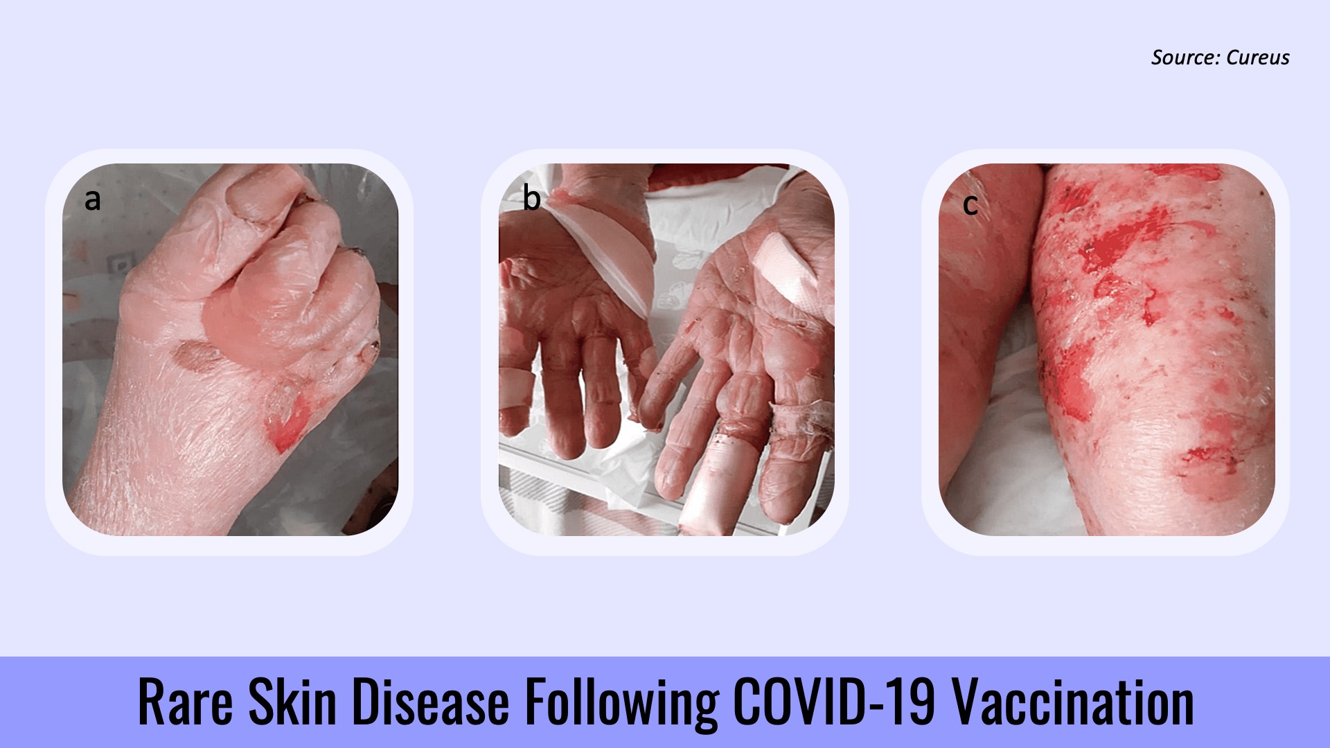 Diagnose This Rare Skin Disease Following COVID-19 Vaccination