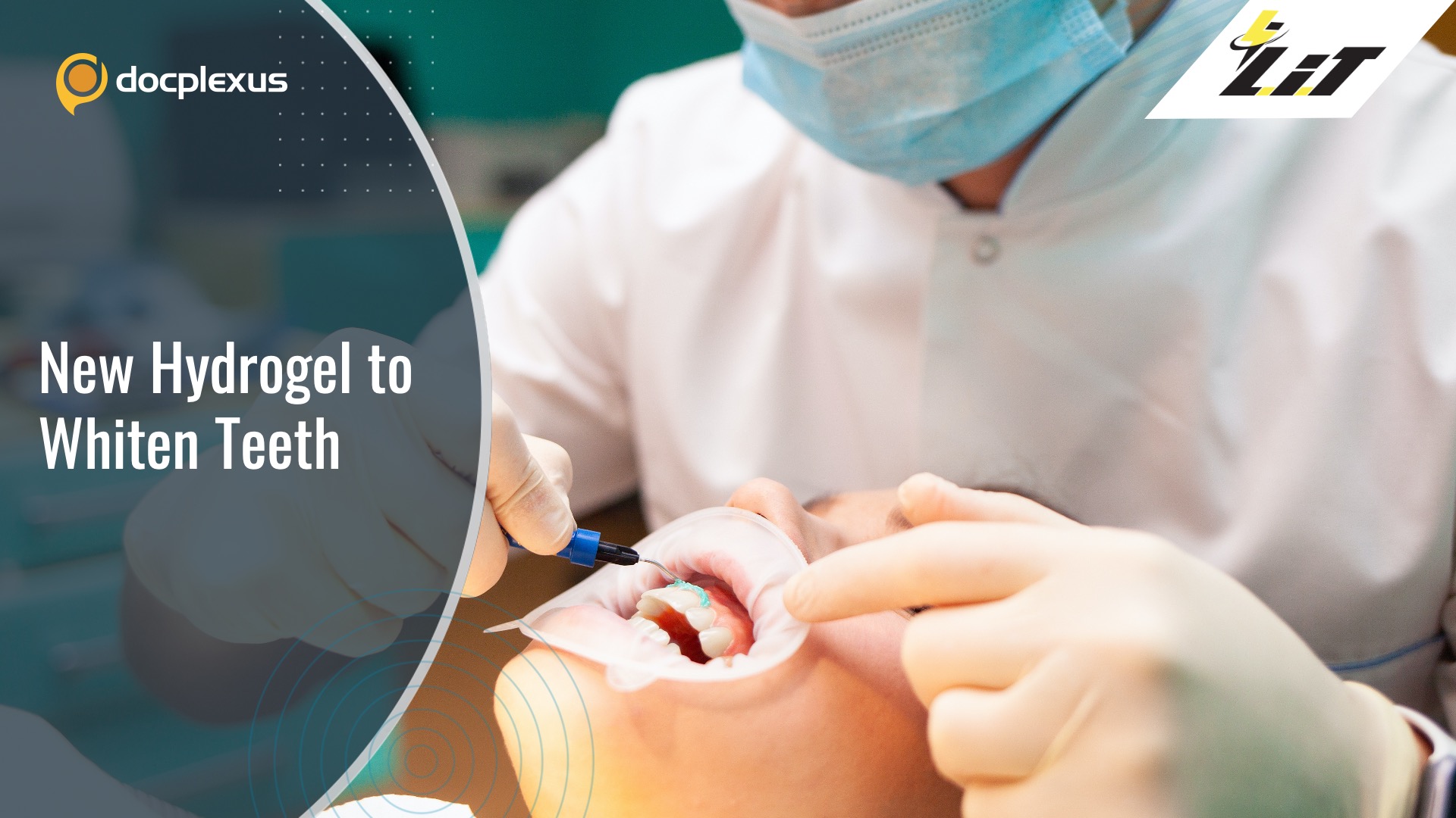 Novel Anticariogenic Tooth-whitening Hydrogel