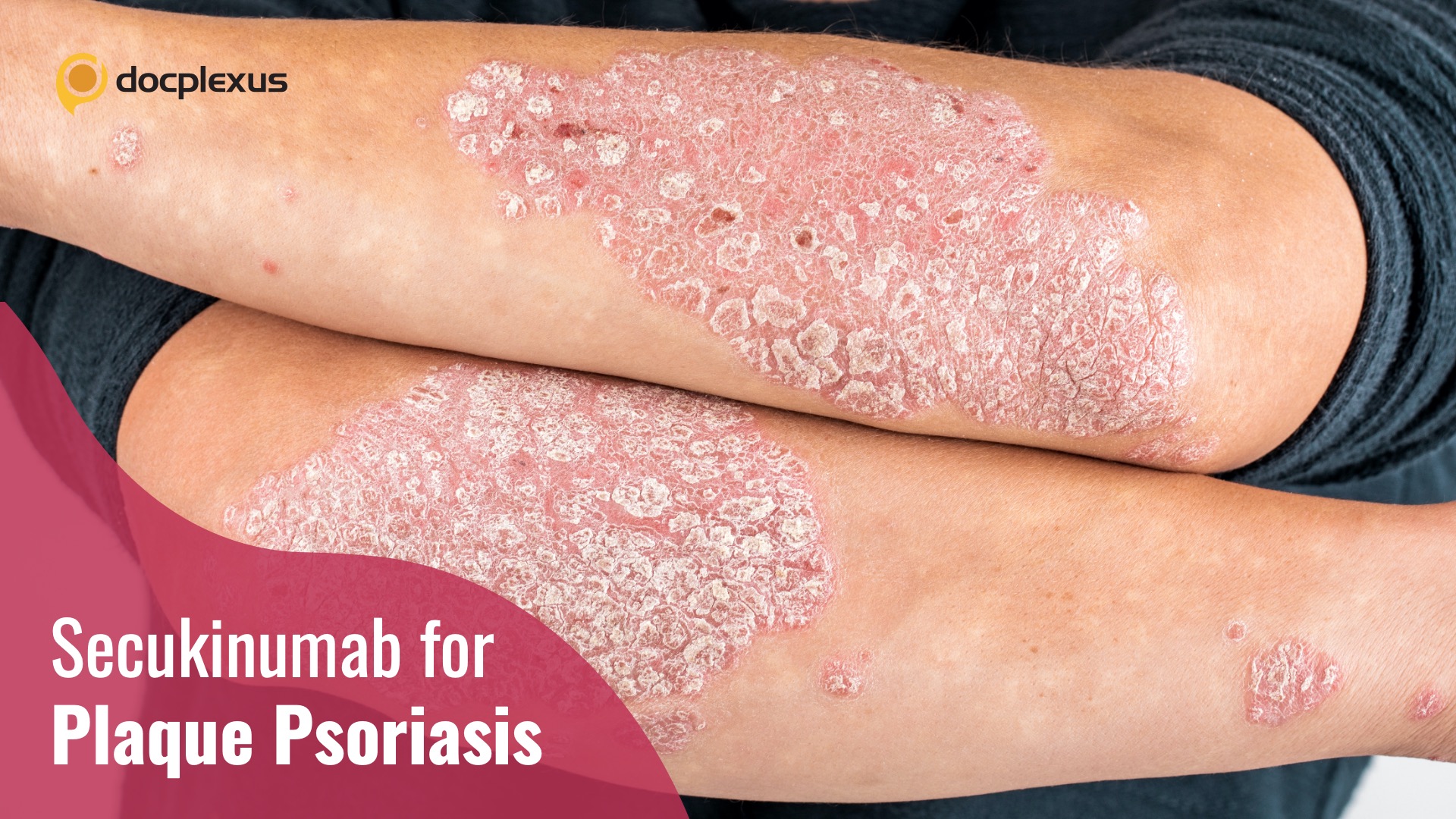 Secukinumab for Plaque Psoriasis: Evidence Based on the Real-world Clinical Scenario
