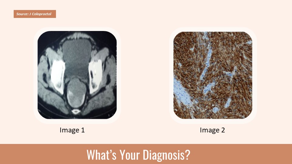 Identify the Rectal Mass