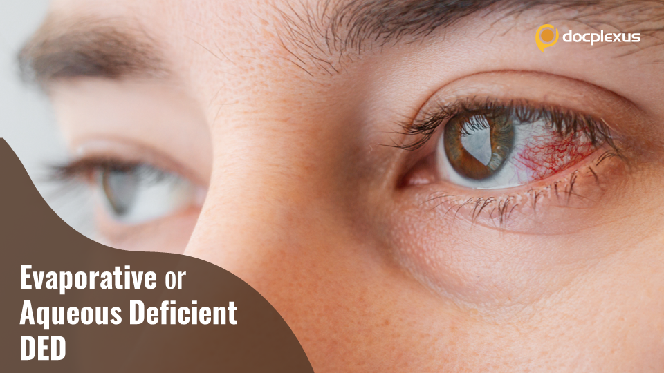 Dissemination of Aqueous-deficient and Evaporative DED: A Retrospective Study