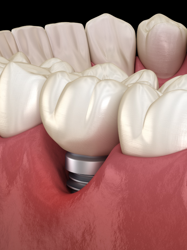 Peri-implantitis Management