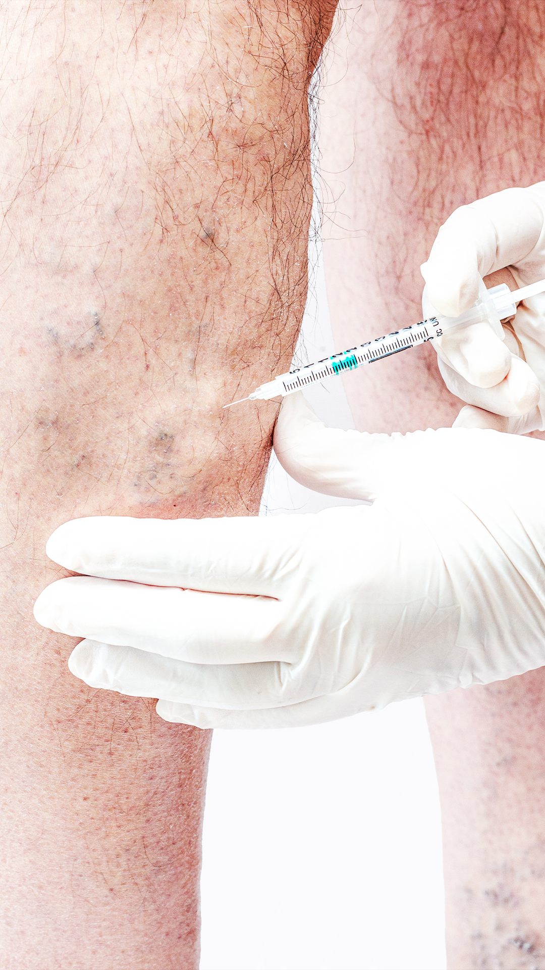 New Evidences in the Treatment of Leg Venous Ulcer
