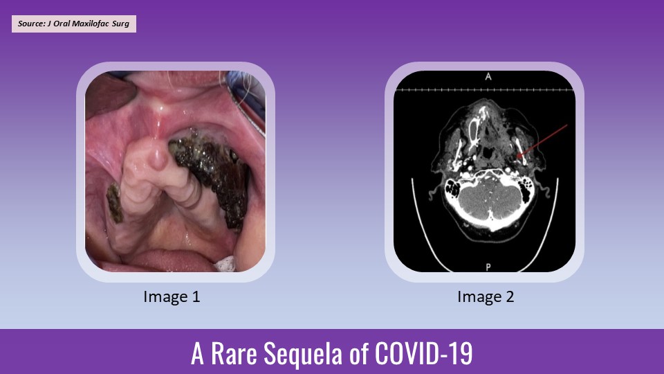 A Case of Bilateral Maxillary Necrosis Secondary to COVID-19 Infection