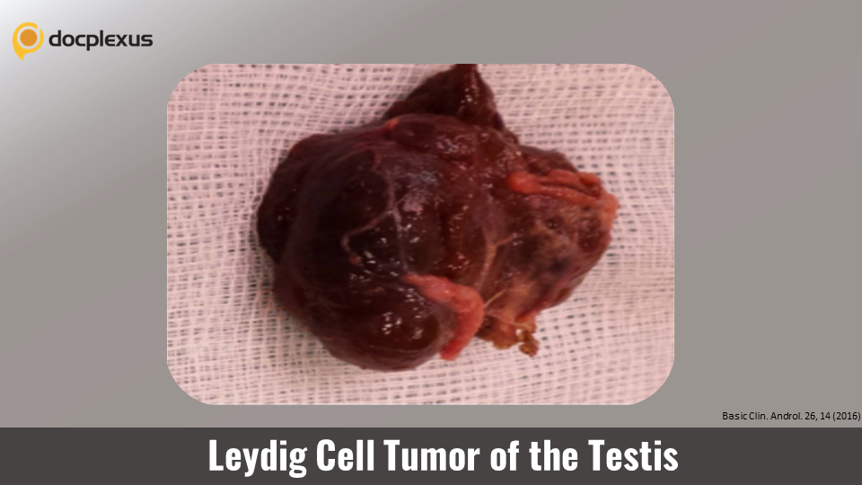 A Case of a 44-year-old Patient with Secondary Infertility