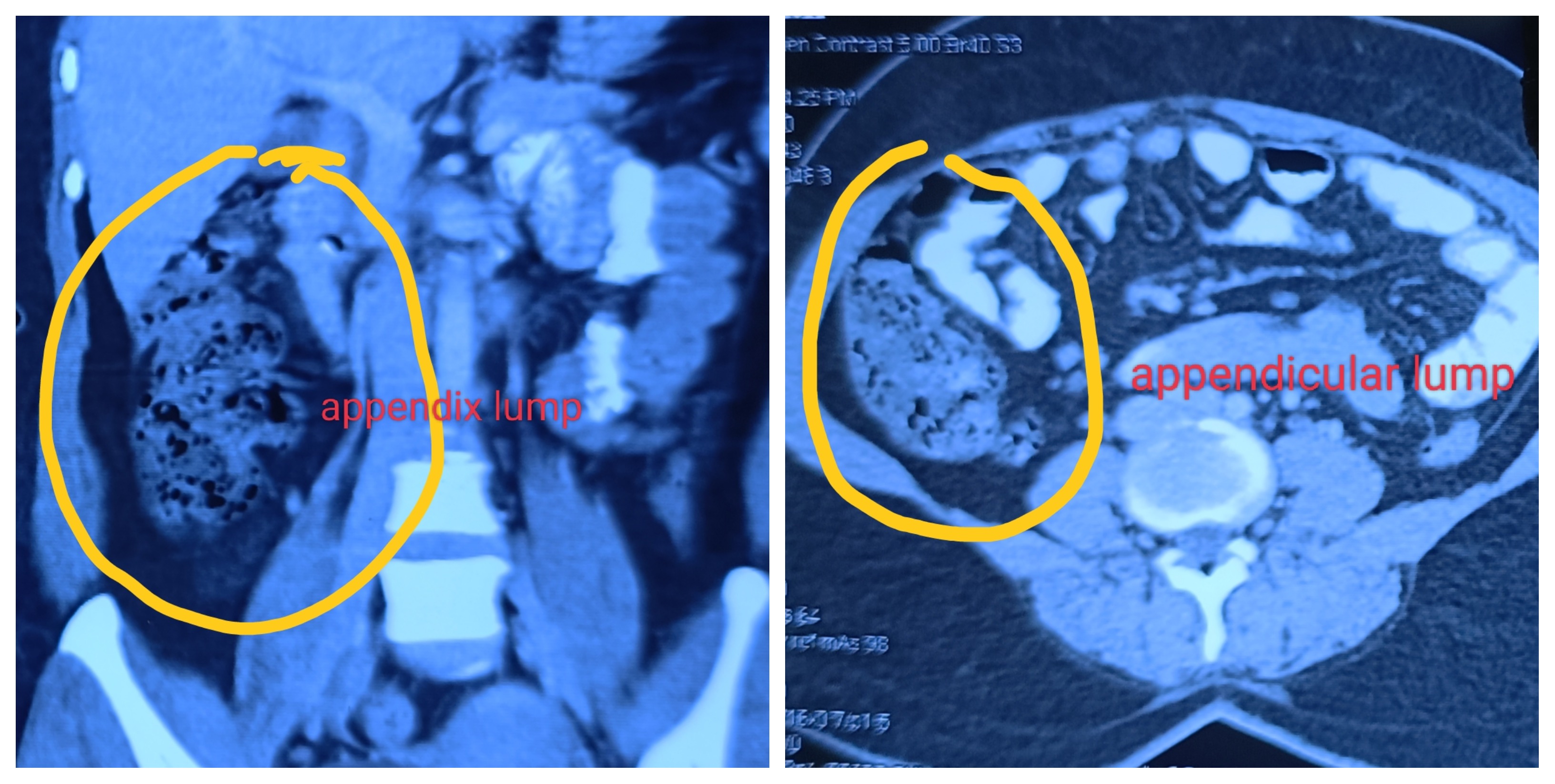 Management Of Appendicular Lump