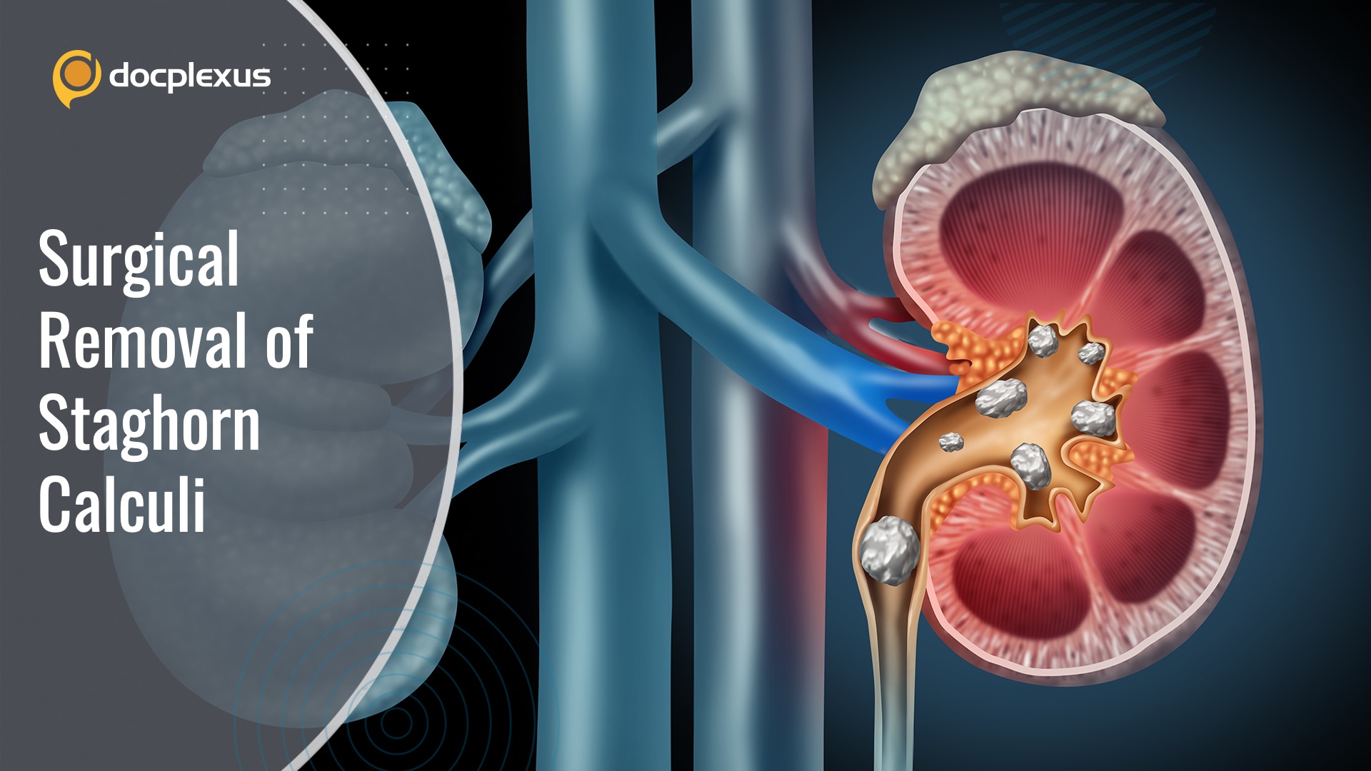 Gold Standard Technique for the Surgical Removal of Staghorn Calculi