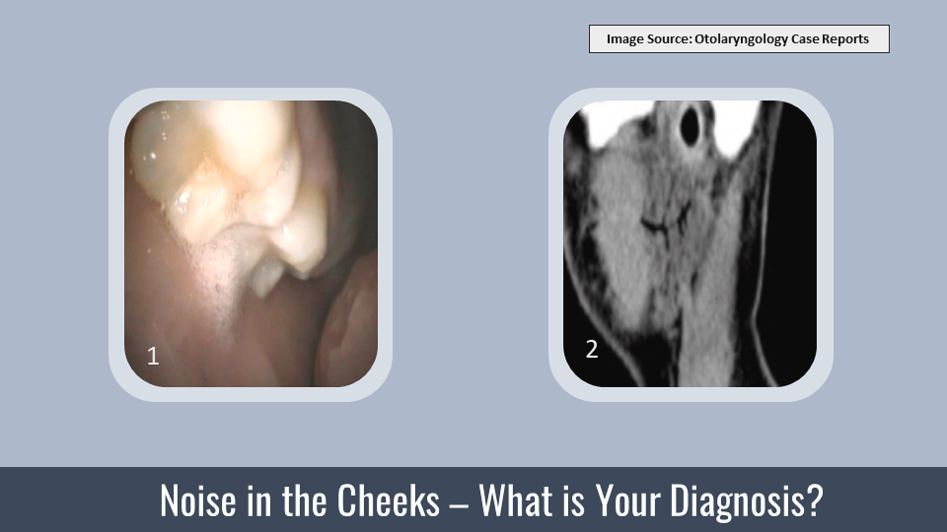 A Case of Sponge Crunching Noise in the Right Preauricular Region