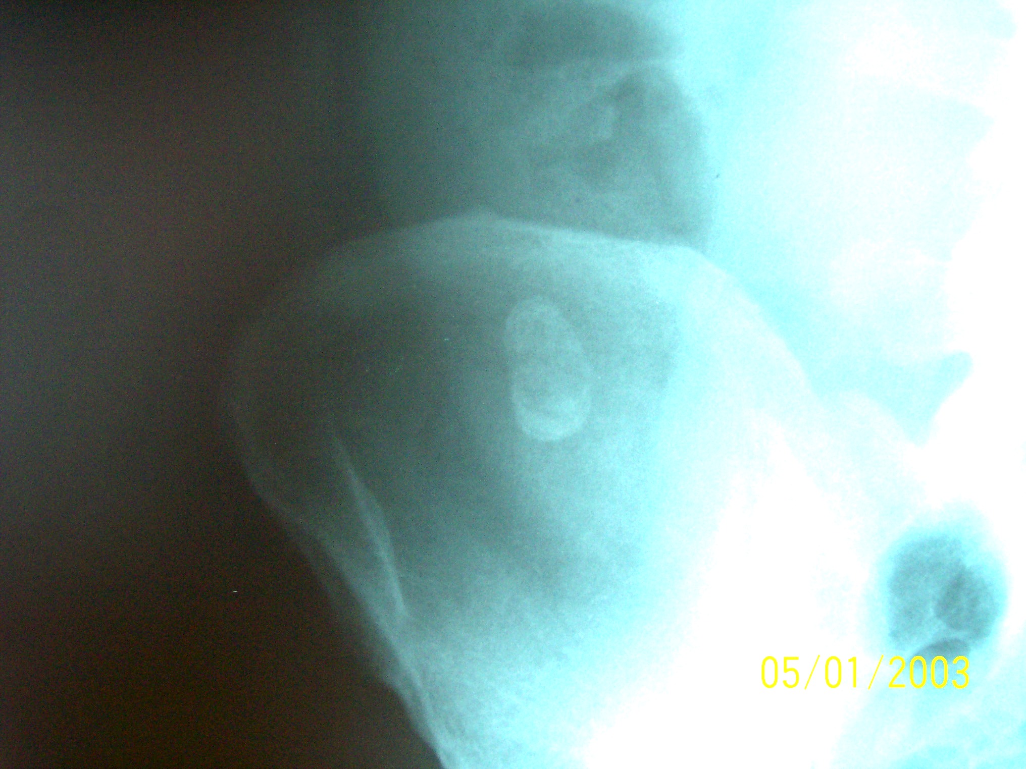 Typical Shadow of Faecolith In Appendix
