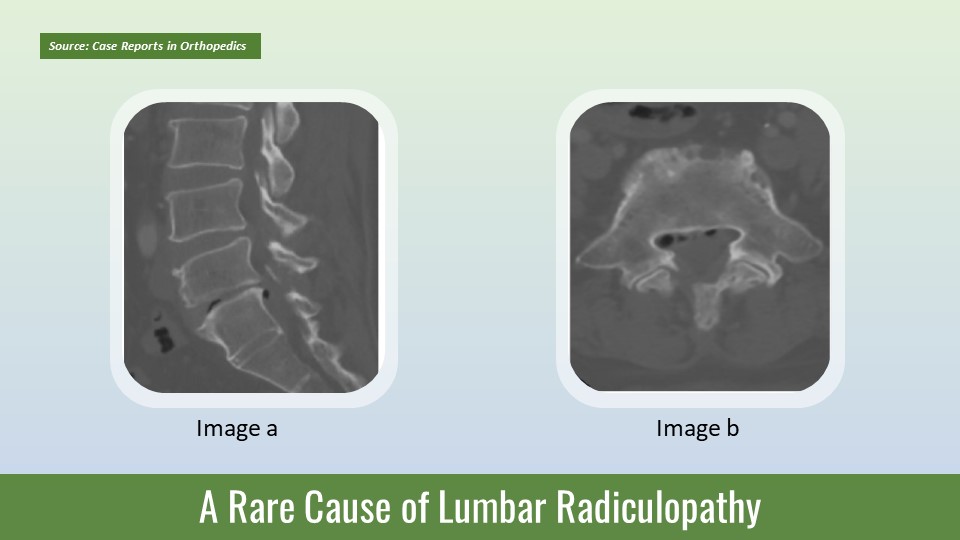 Lumbar Radiculopathy due to Epidural Gas