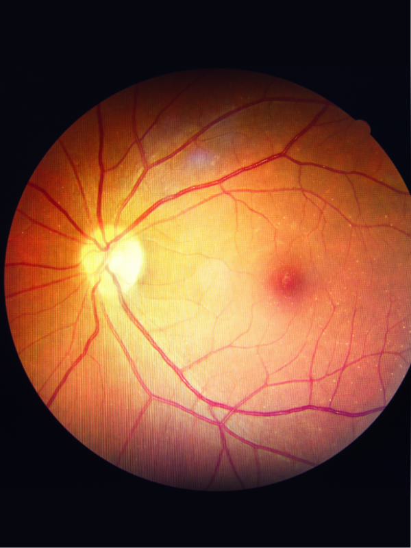 3D Surgery for Diabetic Retinopathy