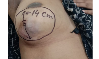 Sarcoma Breast a Rare Disease