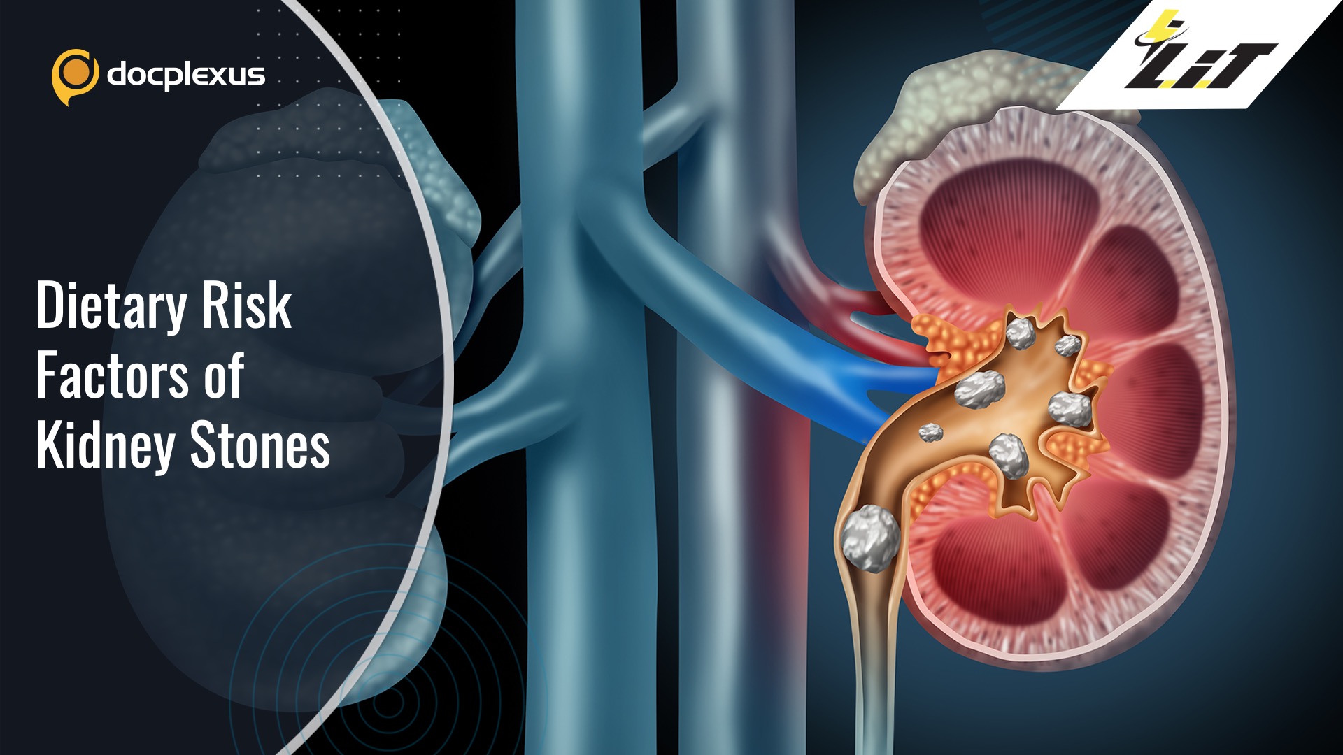 Are Dietary Factors Associated with the Risk of Kidney Stones?