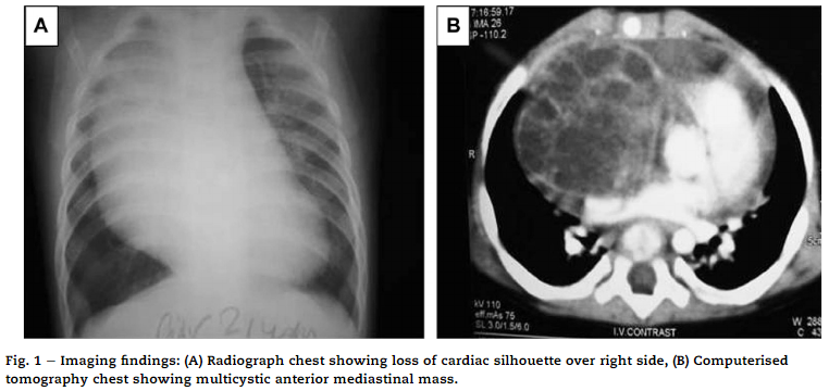 A Rare Case of Intra-pericardial Teratoma Presentingas A Mediastinal Mass in An Infant