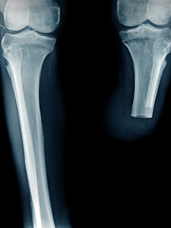 Rotationplasty: A Modified Amputation Surgery
