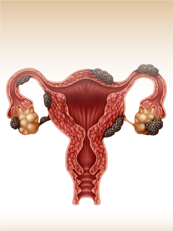 IVF in PCOS