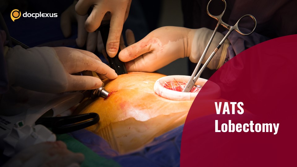 VATS Lobectomy Conversion to Open Thoracotomy