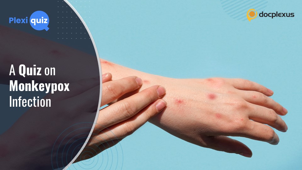 Test Your Knowledge of Monkeypox Infection
