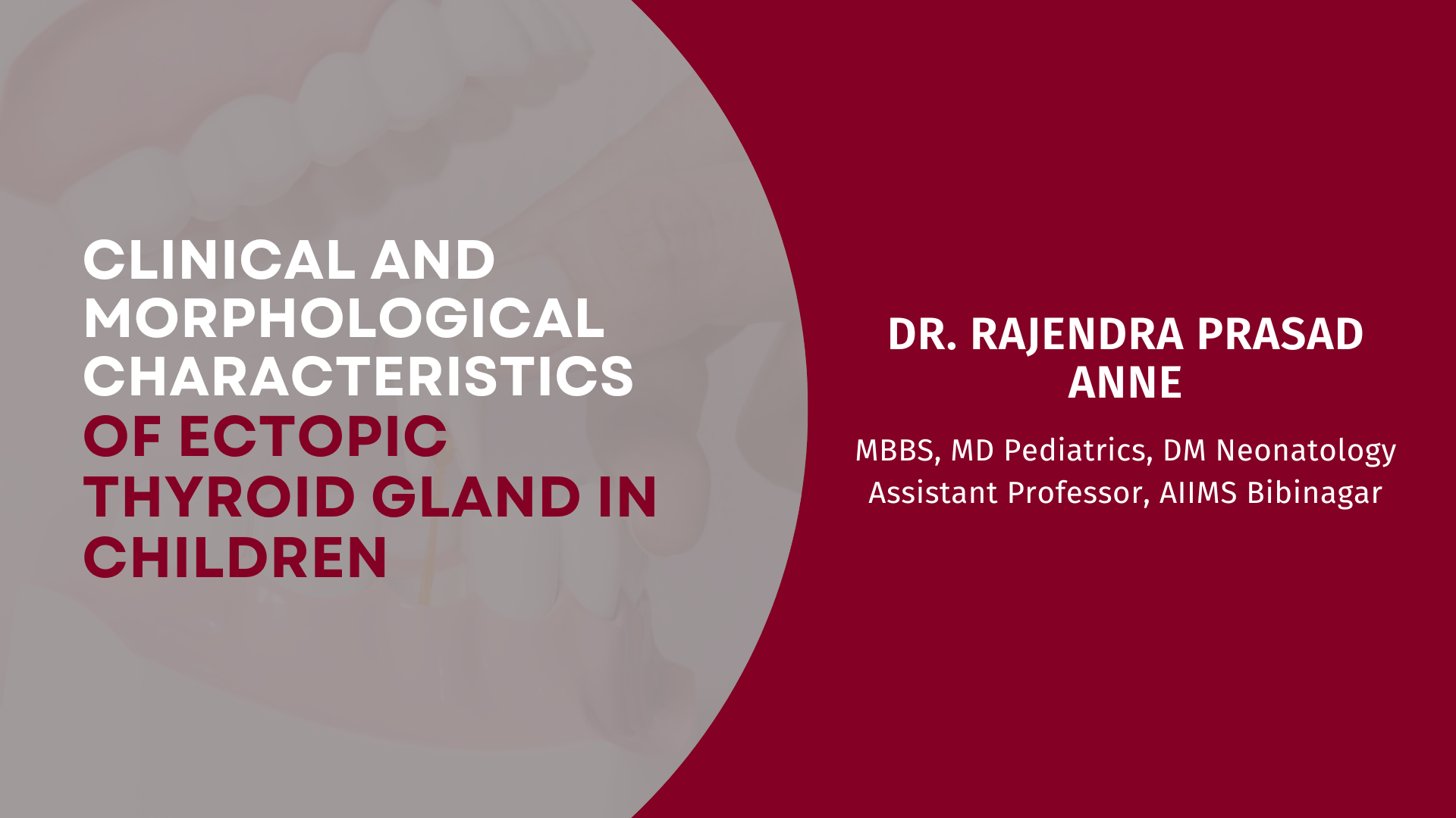 Clinical and Morphological Characteristics of Ectopic Thyroid Gland in Children