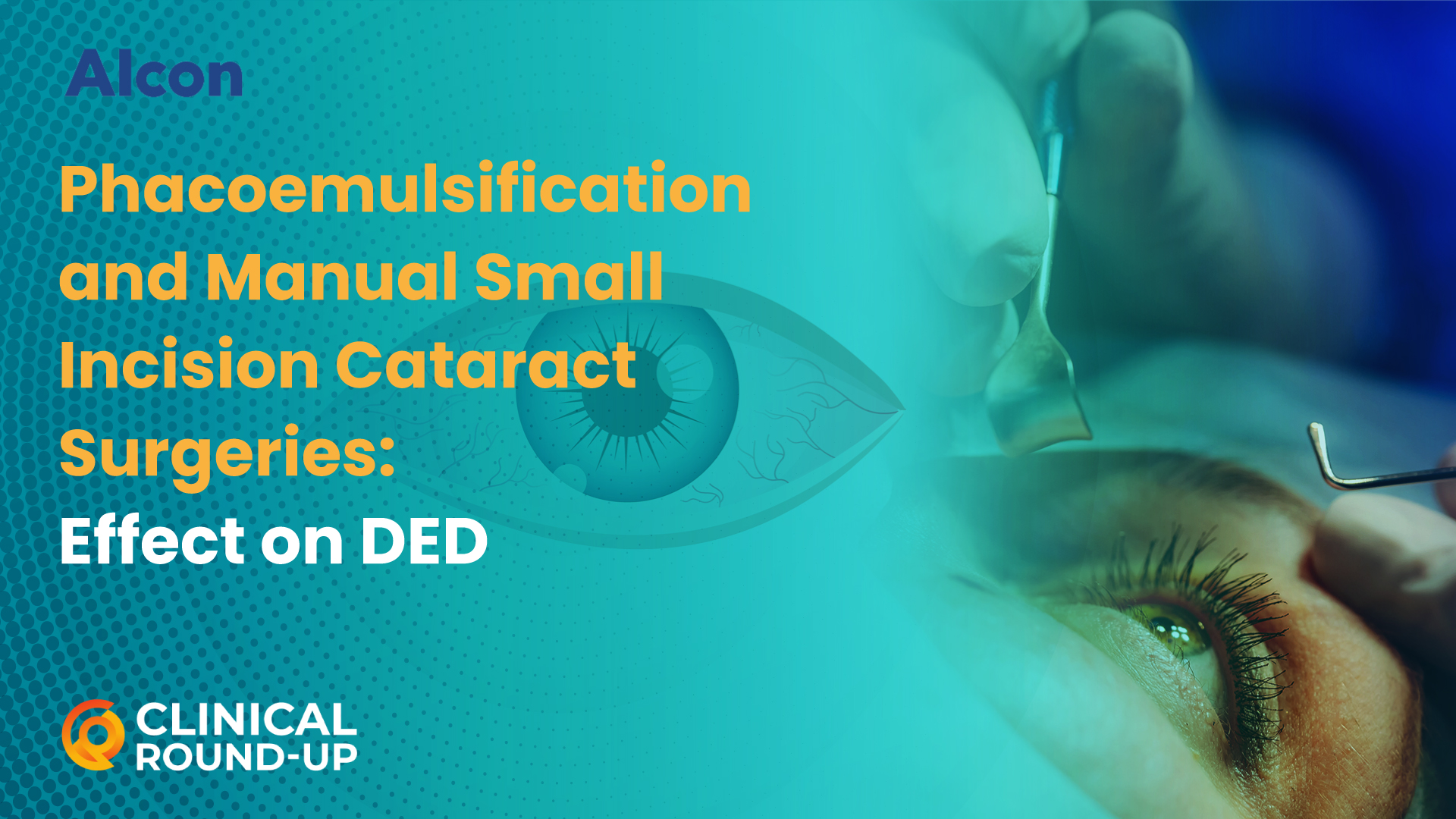 Phacoemulsification and Manual Small Incision Cataract Surgeries: Effect on DED (Clinical Round-up)