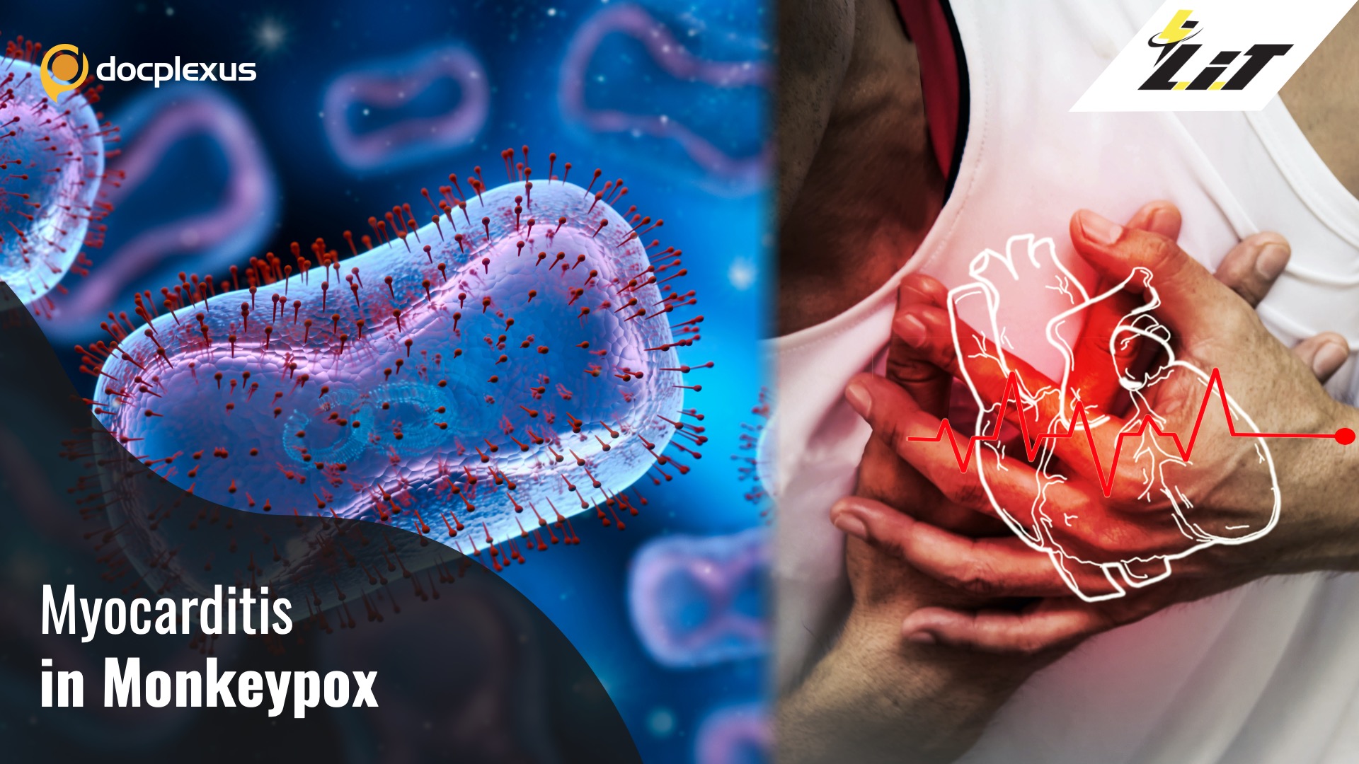 First Case of Myocarditis in Monkeypox Patient