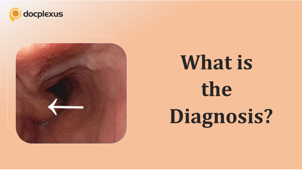 Case of a Woman with Solid Food Stuck in Her Throat
