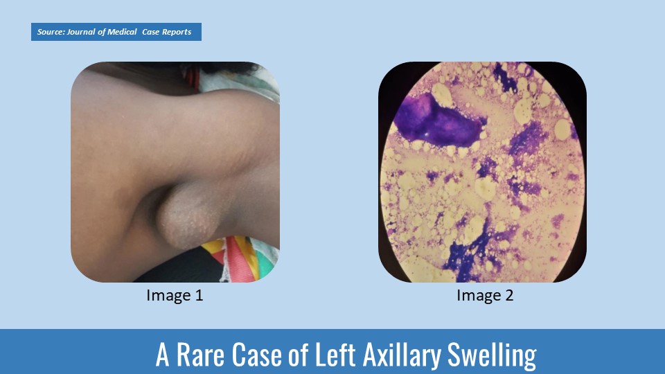 A Case of Fibroadenoma in Accessory Breast Tissue