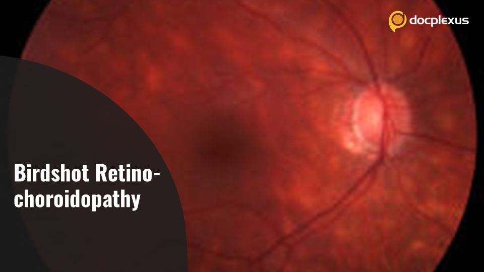 Birdshot Retinochoroidopathy: A Rare Chronic Inflammatory Eye Disease