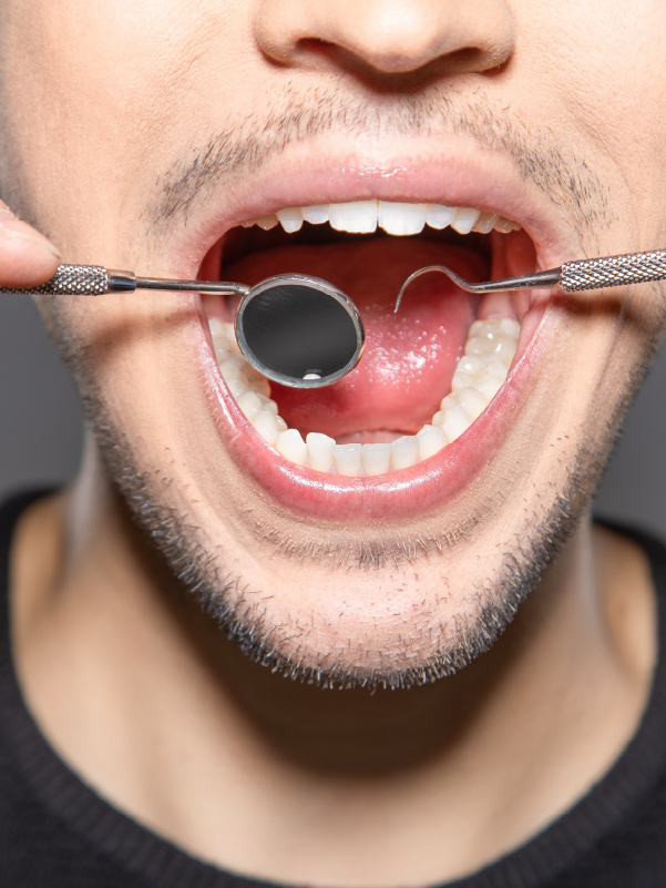 Mouth Self-examination for Oral Cancer