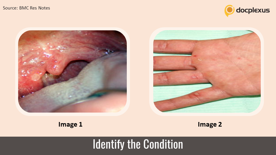 Adult with Blisters on Hands and Feet