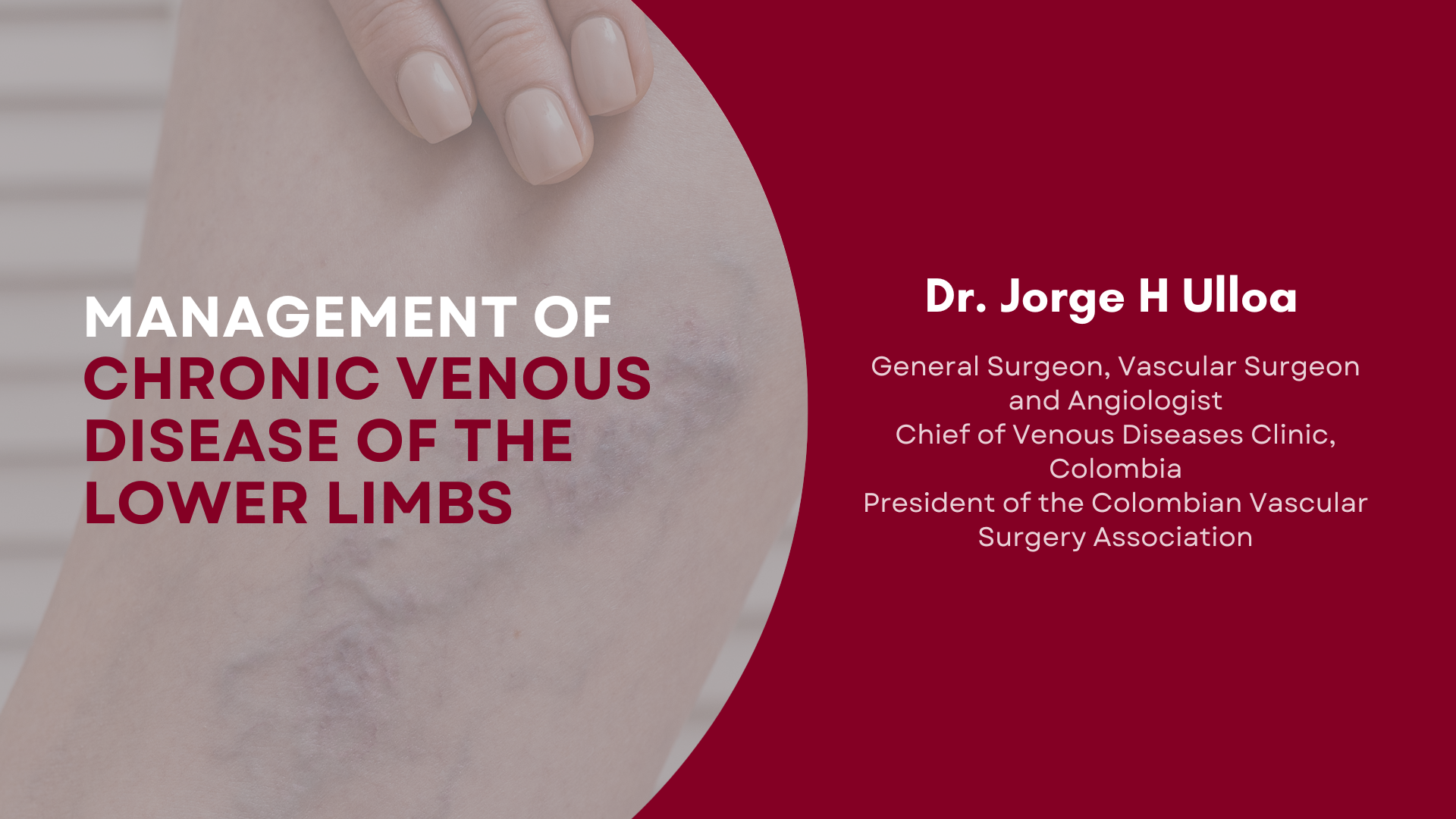 Chronic Venous Disease of the Lower Limbs Management: ESVS 2022 Guidelines