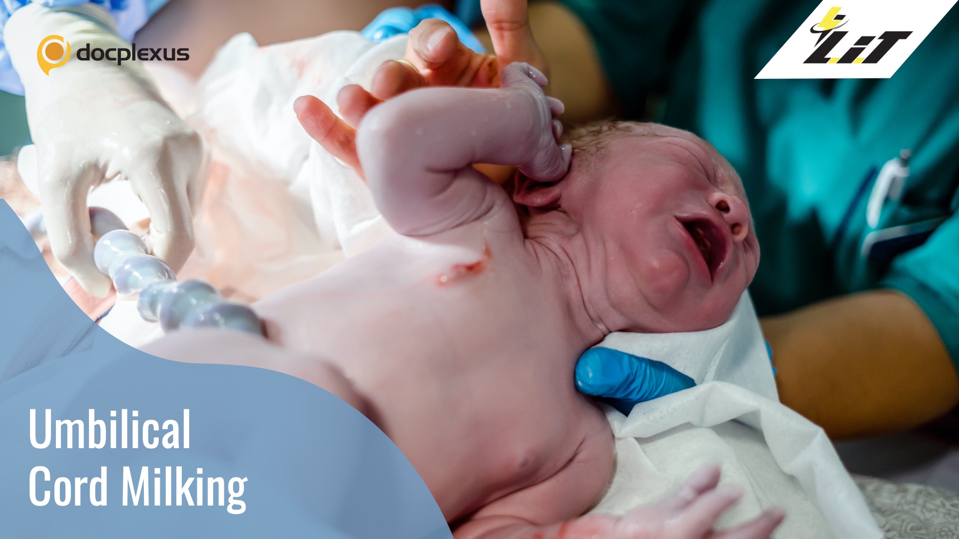 How Effective is Umbilical Cord Milking for Nonvigorous Newborns?