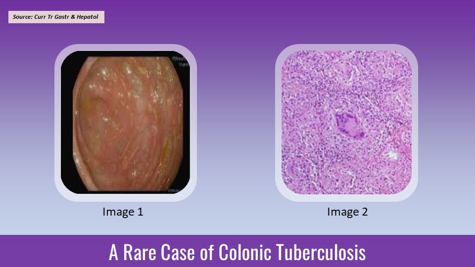 Diagnostic Dilemma of Colonic Tuberculosis