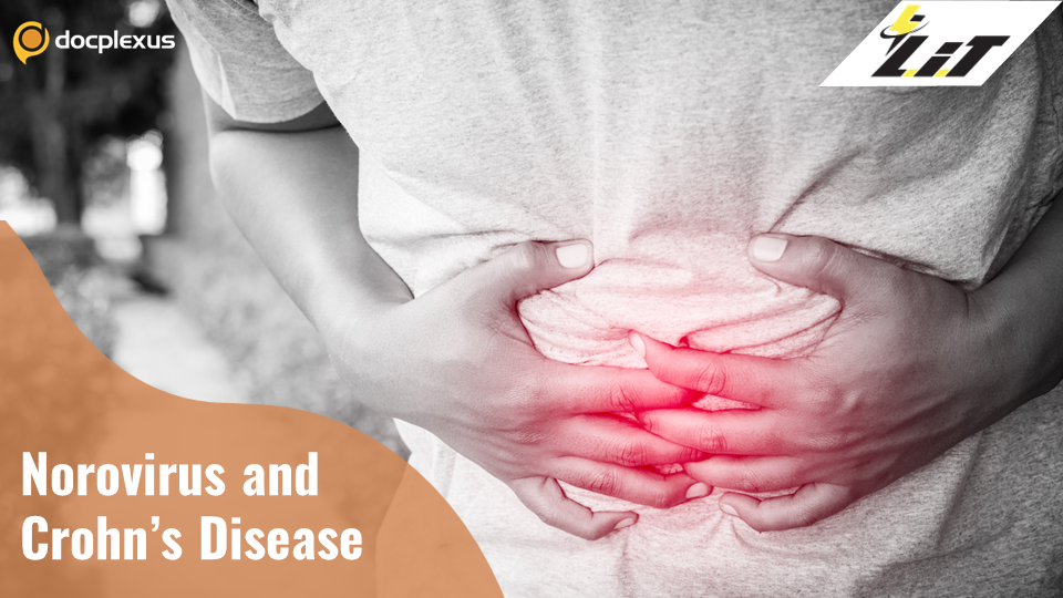 Norovirus and Crohn’s Disease: Are They Linked?