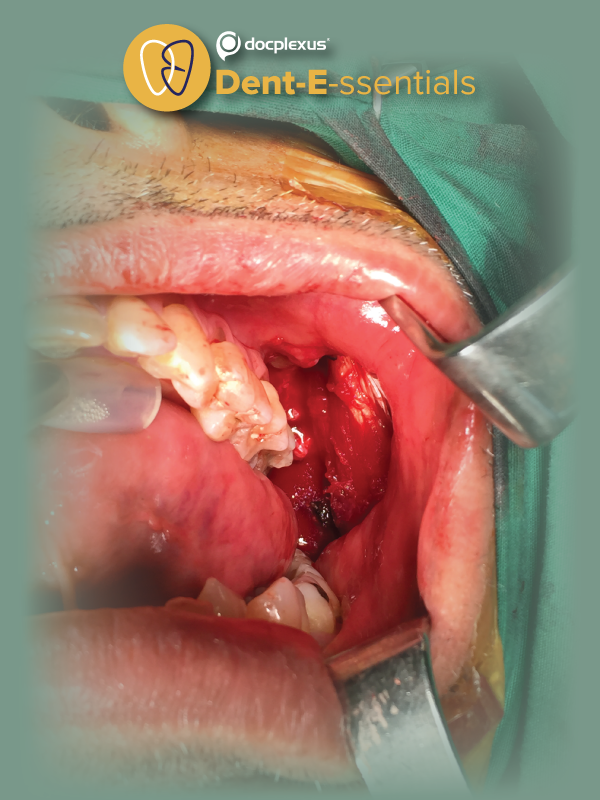 Oral Mucositis: An Urgent and Unmet Need of Cancer Patients