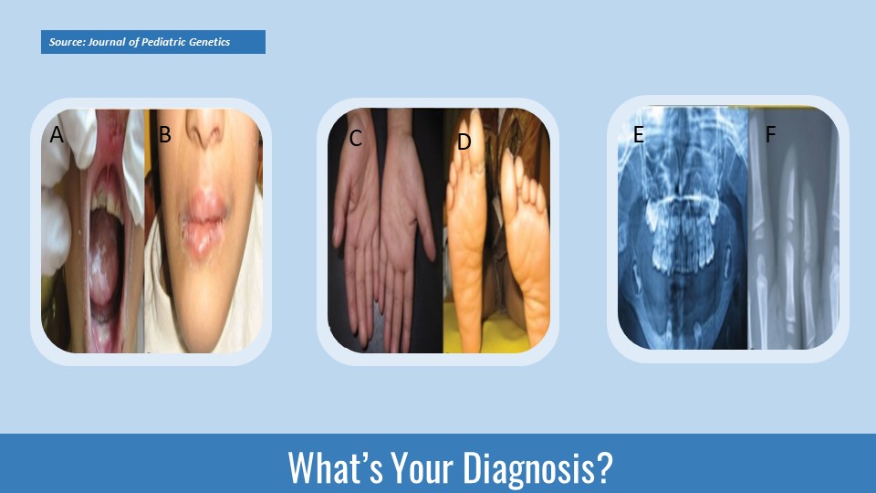 Can You Guess the Condition Causing Teeth Loss?
