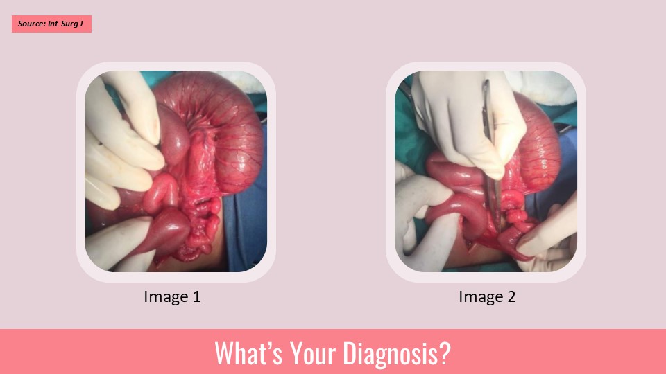 Identify the Intestinal Anomaly in This Newborn